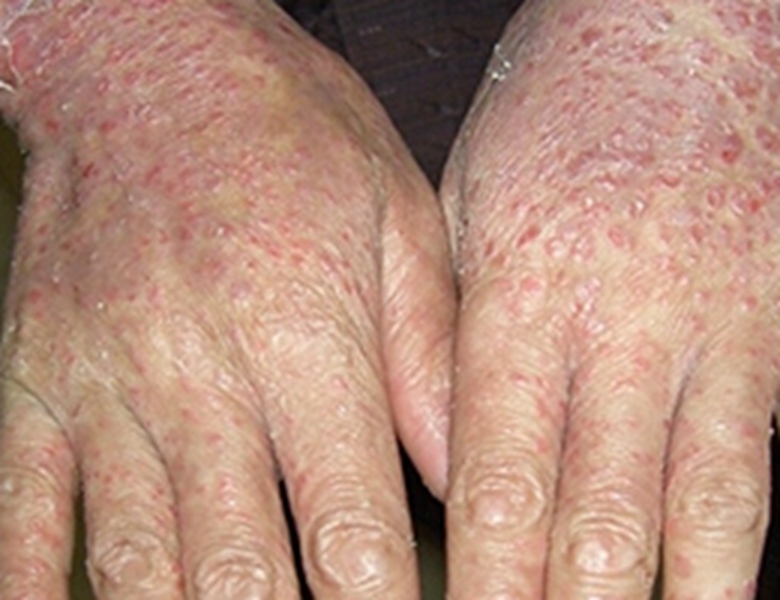 皮膚黃色瘤病手部症狀