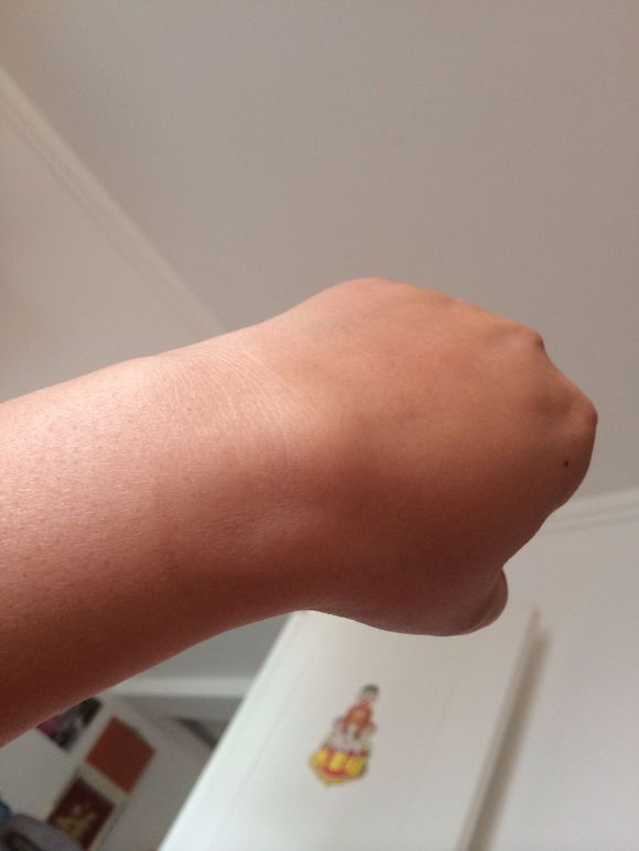 左手腕背面手腕腱鞘炎