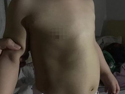 寶寶缺鈣雞胸圖 (59) 