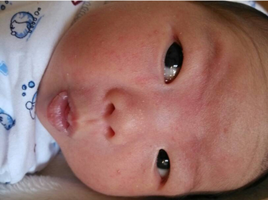 新生兒胎毒的症狀