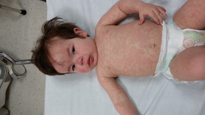 嬰兒蕁麻疹 (49) 