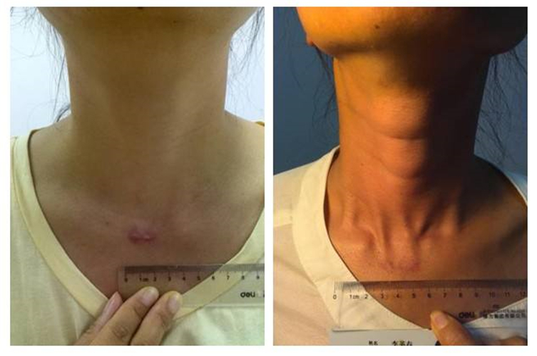 微創治療甲狀腺癌效果