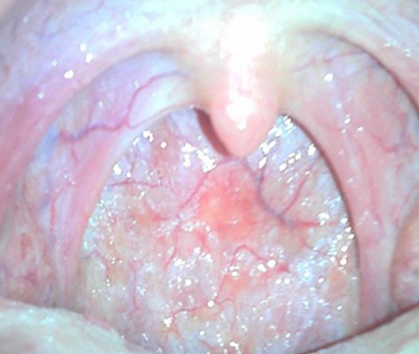 嚴重的急性咽炎