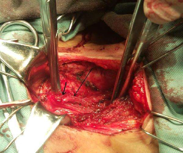 易被誤診的甲狀腺癌