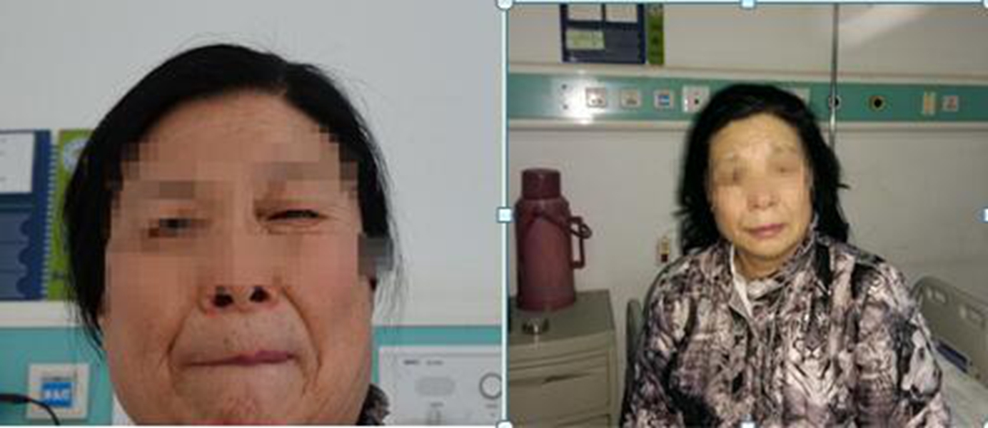 中老年面肌痙攣術前後對比