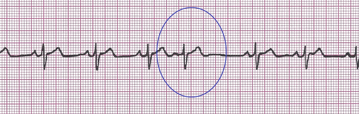 頻發房性早搏 (44) 