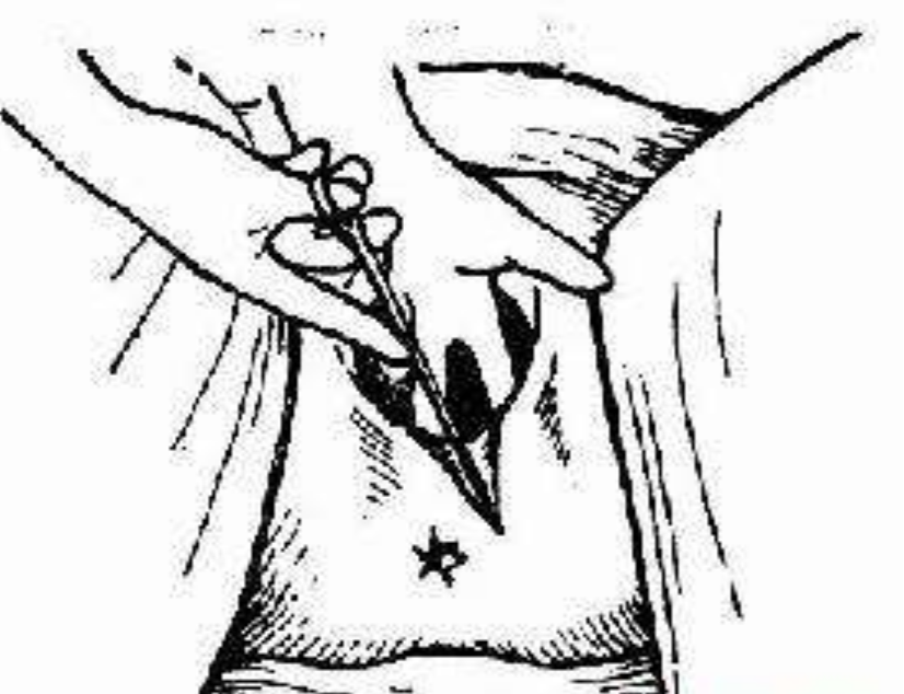 三度會陰撕裂手術的