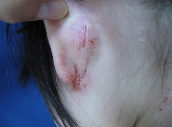 耳後患異位性皮炎