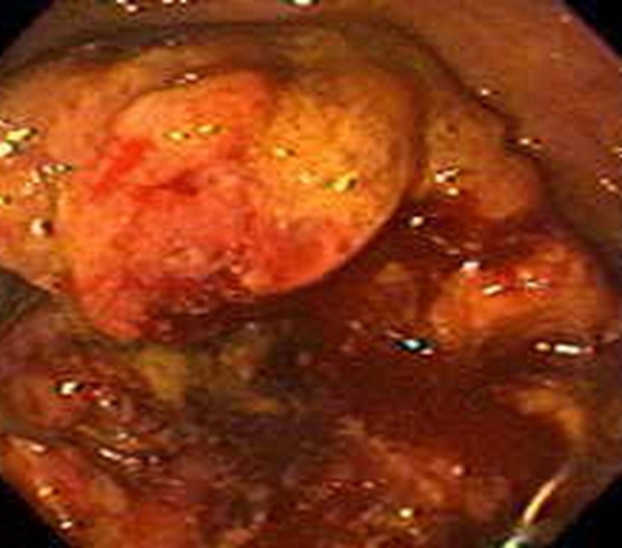 右半結腸癌的未分化癌常見臨床 特點