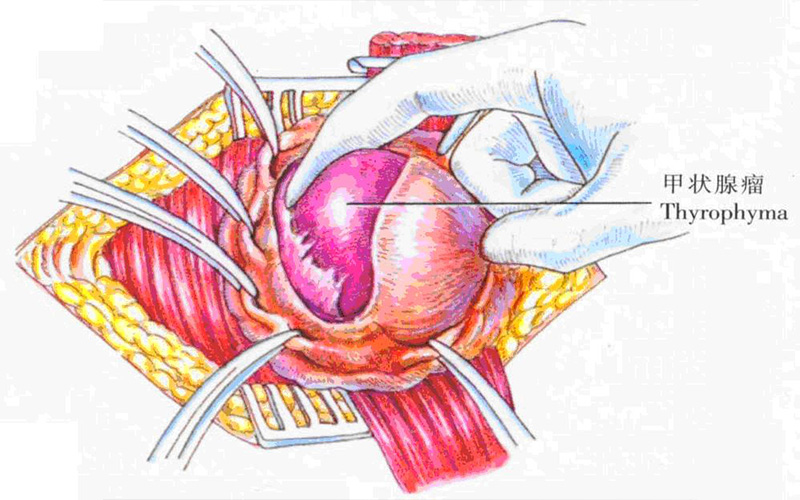 甲狀腺瘤的表現 