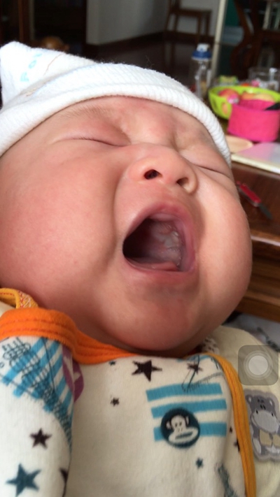 口腔念珠菌感染 (7) 