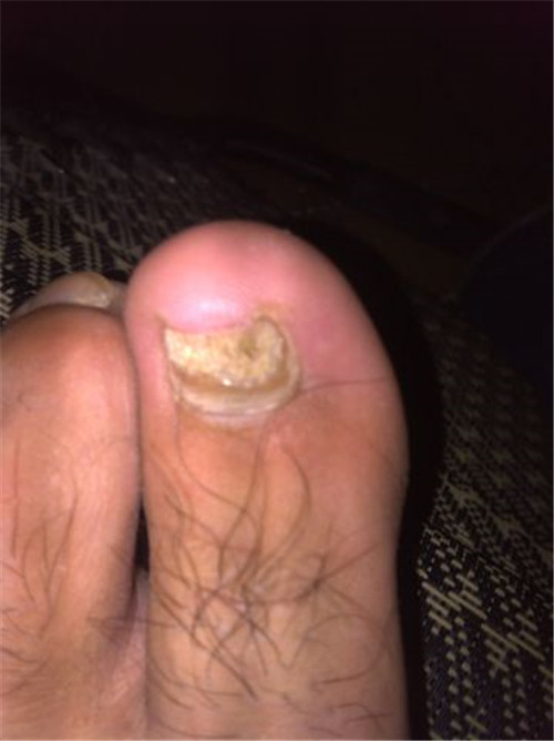 男白色念珠菌感染 