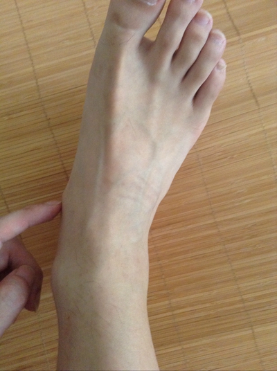 腳骨頭突出 (39) 