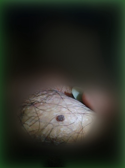 男性尖銳溼疣照片 (45) 