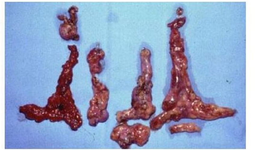 髓養甲狀腺癌伴淋巴轉移
