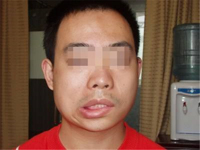 腦供血不足嘴角歪斜