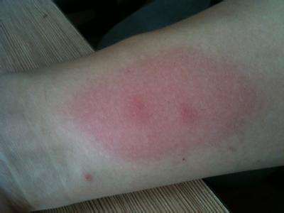 被跳蚤咬的症狀