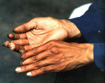 脈管炎早期症狀