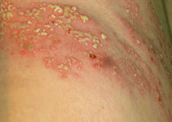 帶狀皰疹樣外觀