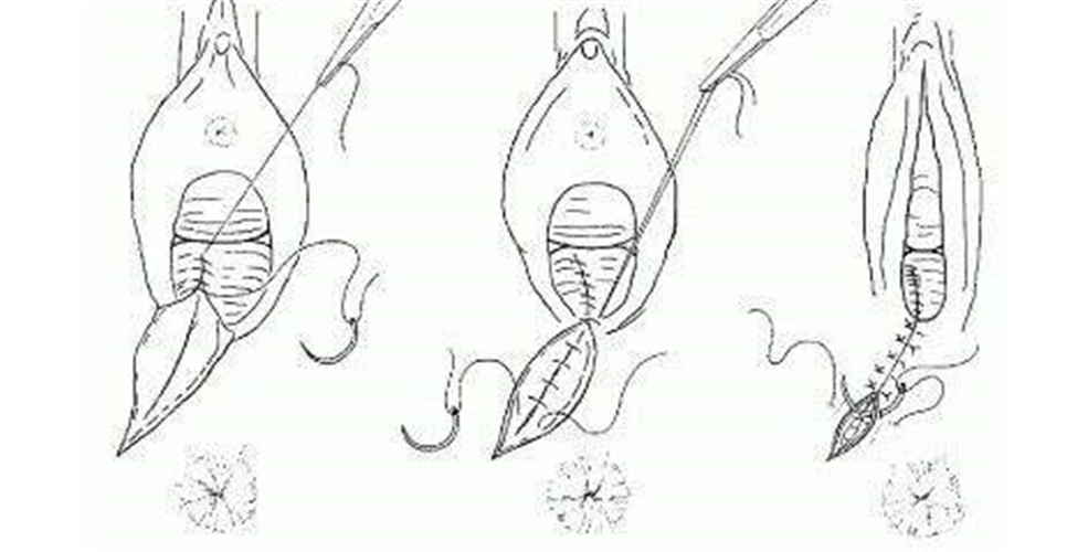 生產會陰撕裂縫合