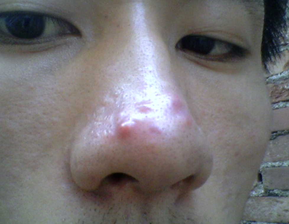 臉上皮囊炎症狀 