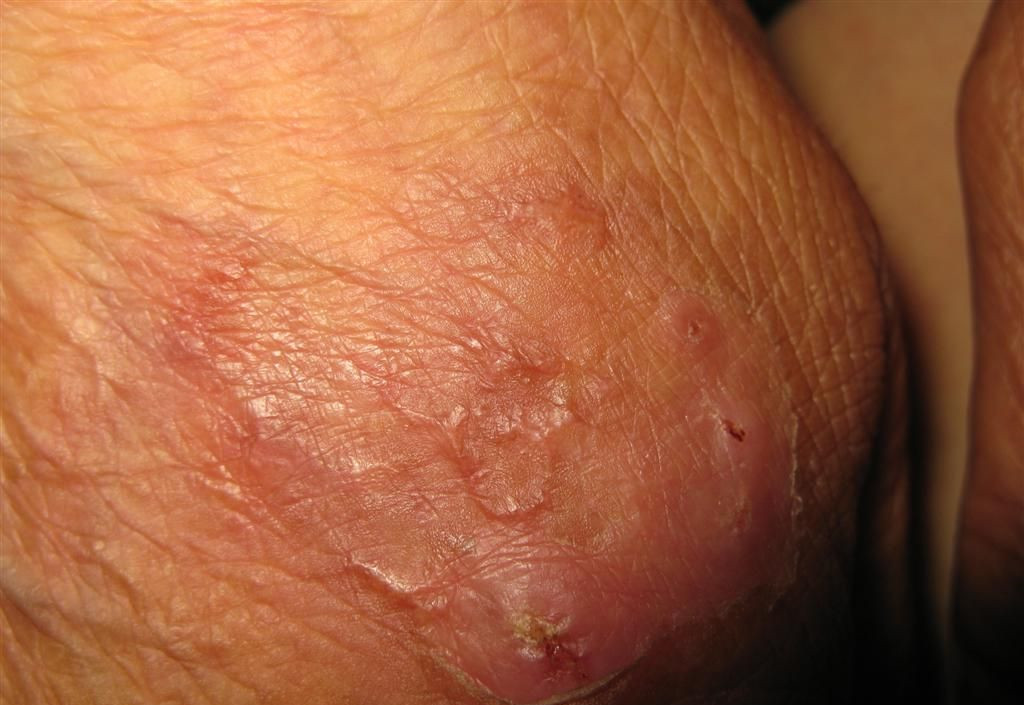 瘰癧性皮膚結核病