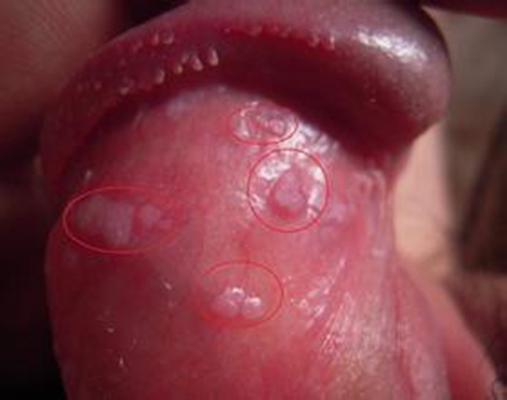 性病性淋巴肉芽腫套圖 (48) 