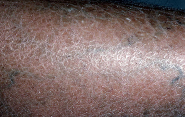 小腿皮膚像魚鱗 (49) 