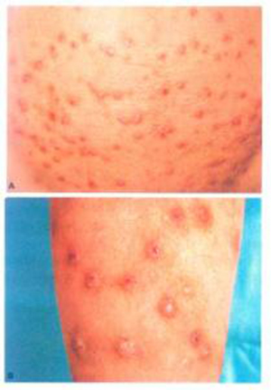 結節性癢疹 (32) 