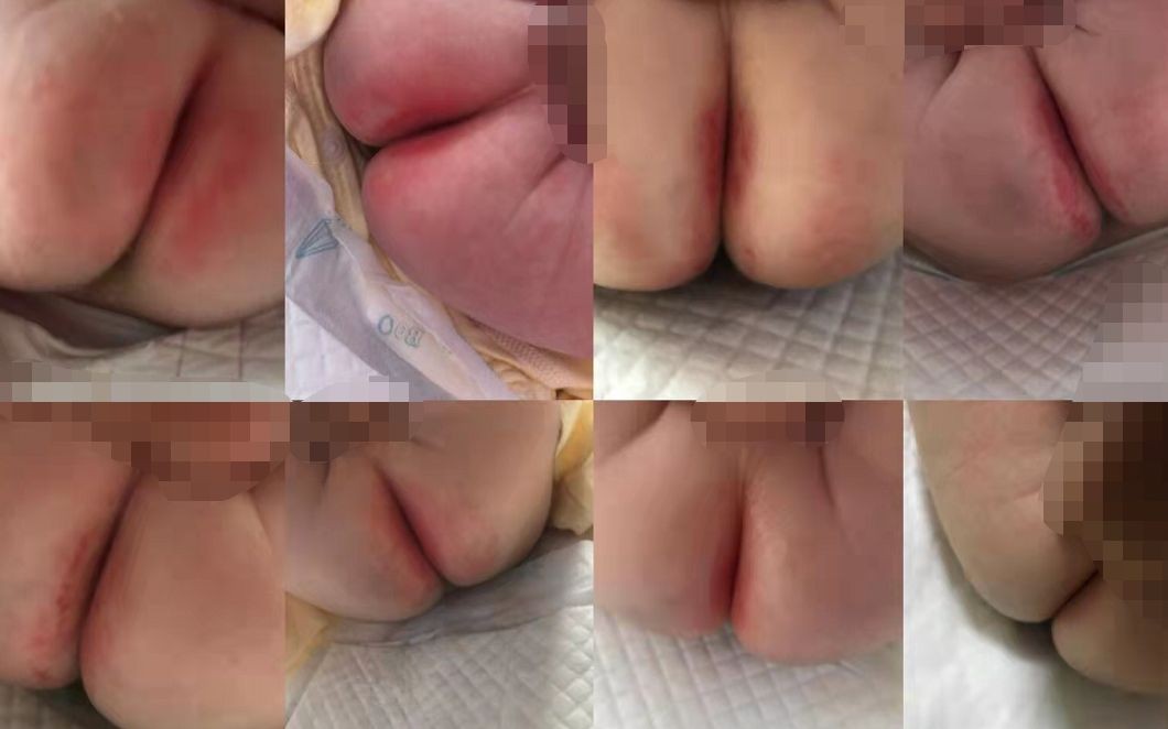 寶寶紅屁屁照片 (6) 