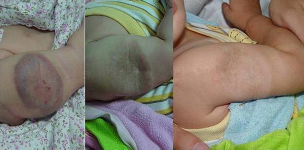 真性皮膚腫瘤的