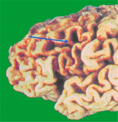 營養不良性腦萎縮