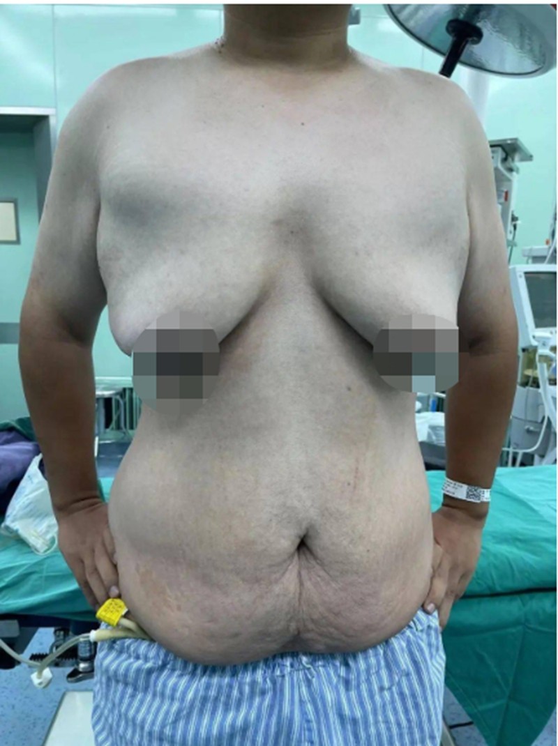 男性巨乳症示意