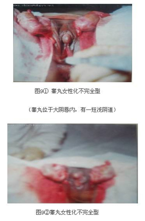 男性假兩性畸形組圖