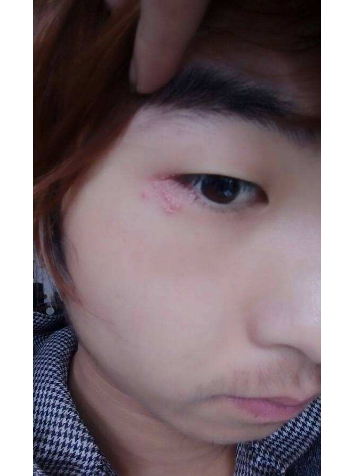 眼睛麥粒腫初期