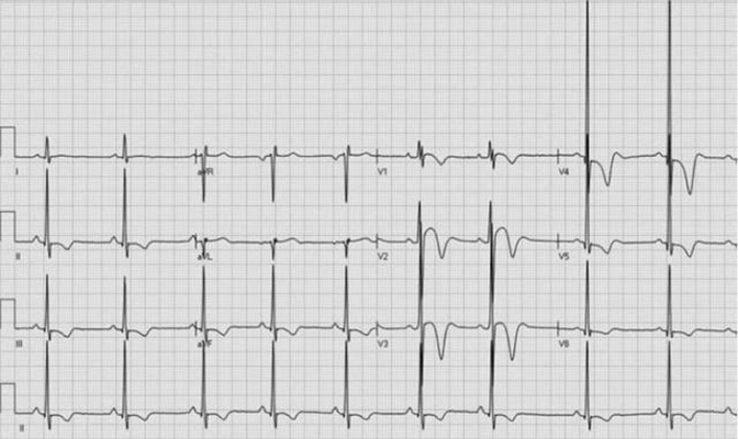 預激綜合徵心電圖 (96) 
