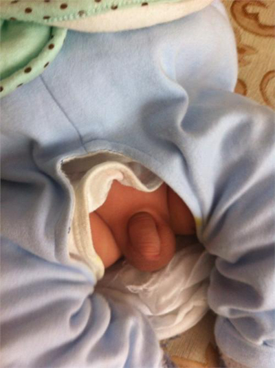 男寶寶疝氣的症狀