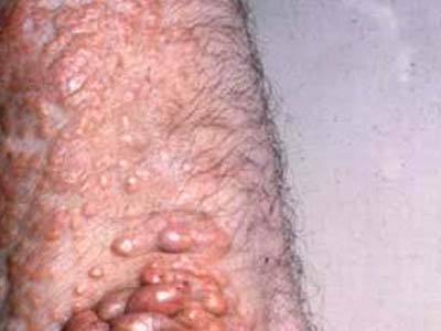 皮淋巴癌早期症狀