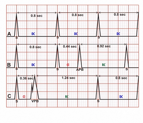 頻發房性早搏 (50) 