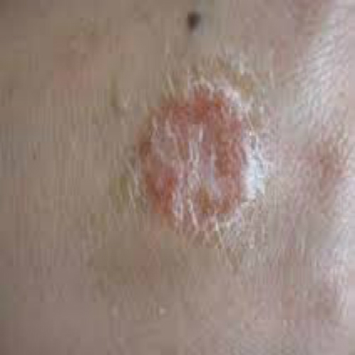 外陰溼疹症狀及