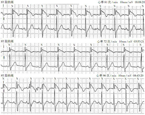 房顫心電圖特點 (69) 