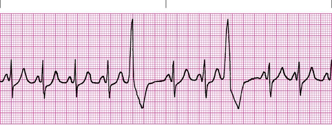 頻發房性早搏 (38) 