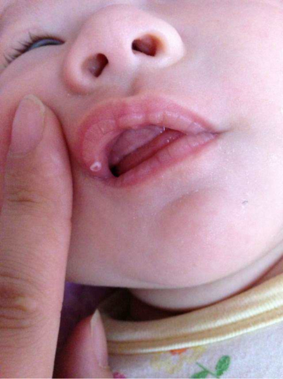 寶寶鵝口瘡 (64) 