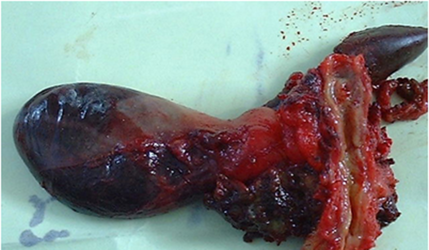 肝門區膽管癌後期症狀