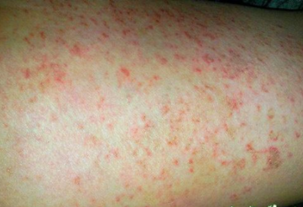 玫瑰糠疹母斑