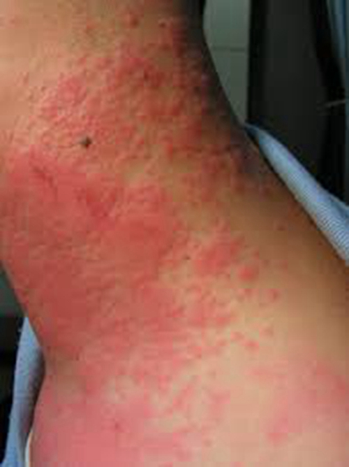 男性脖子夏季皮炎