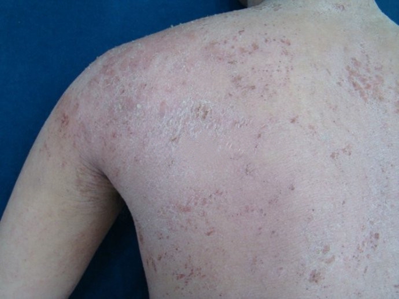 背部異位性皮炎