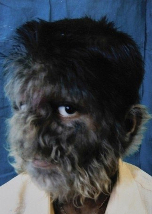 藥物引起多毛症