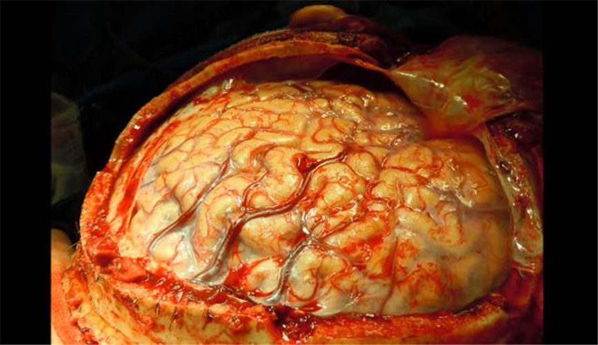 手術治療腦疝止血觀察