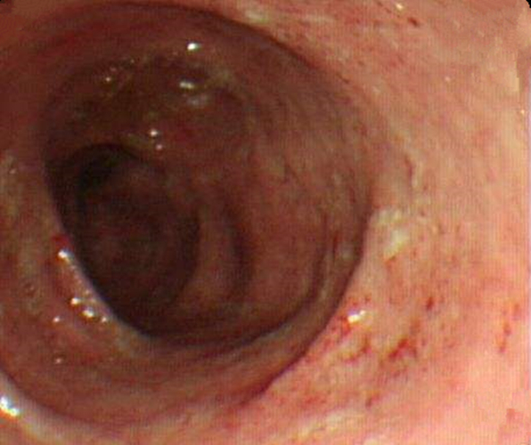 缺血性慢性結腸炎患者